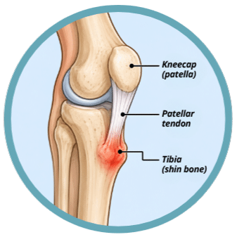 Kneecap (patella) (1) Diagram of the knee showing the kneecap (patella), patellar tendon and tibia (shin bone)